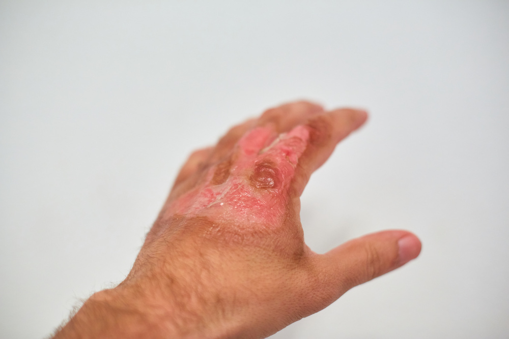 new skin on the hand after a burn, healing burn on the body